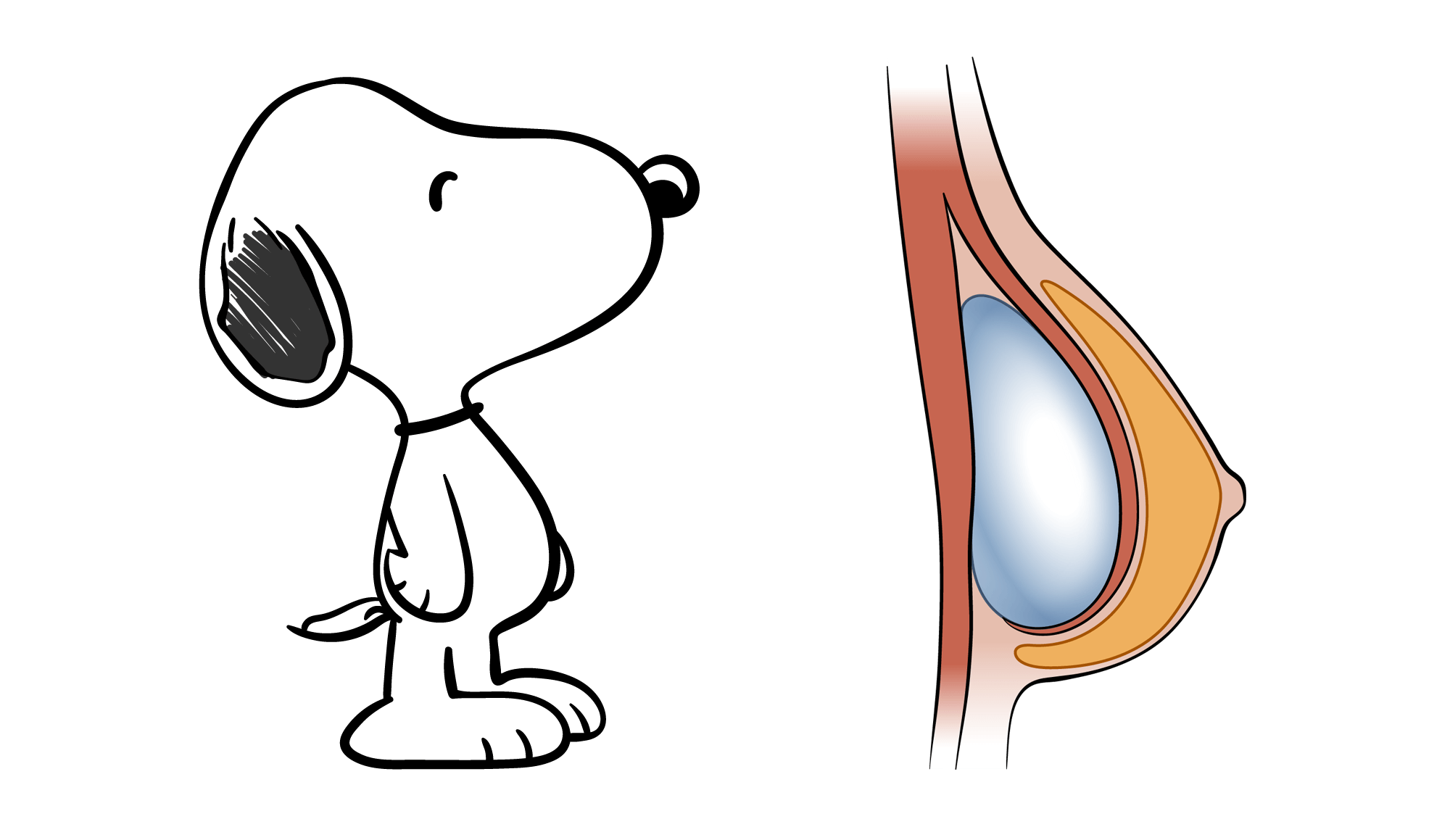 Before After Snoopy Breast Deformity