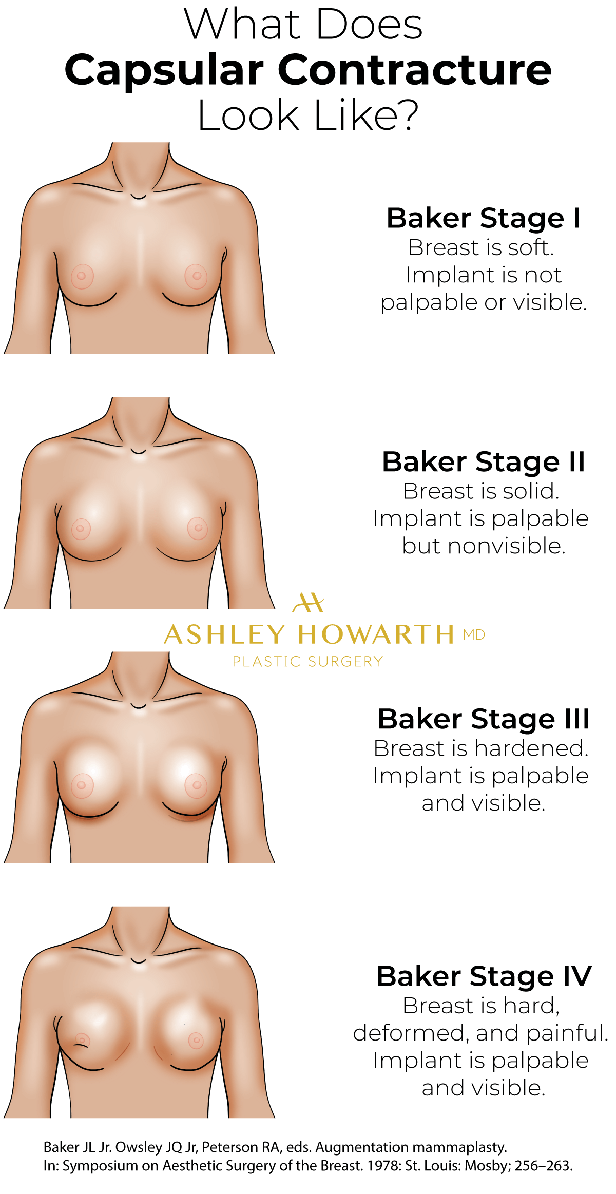 What does Capsular Contracture look like? Baker Stage 1 2 3 4