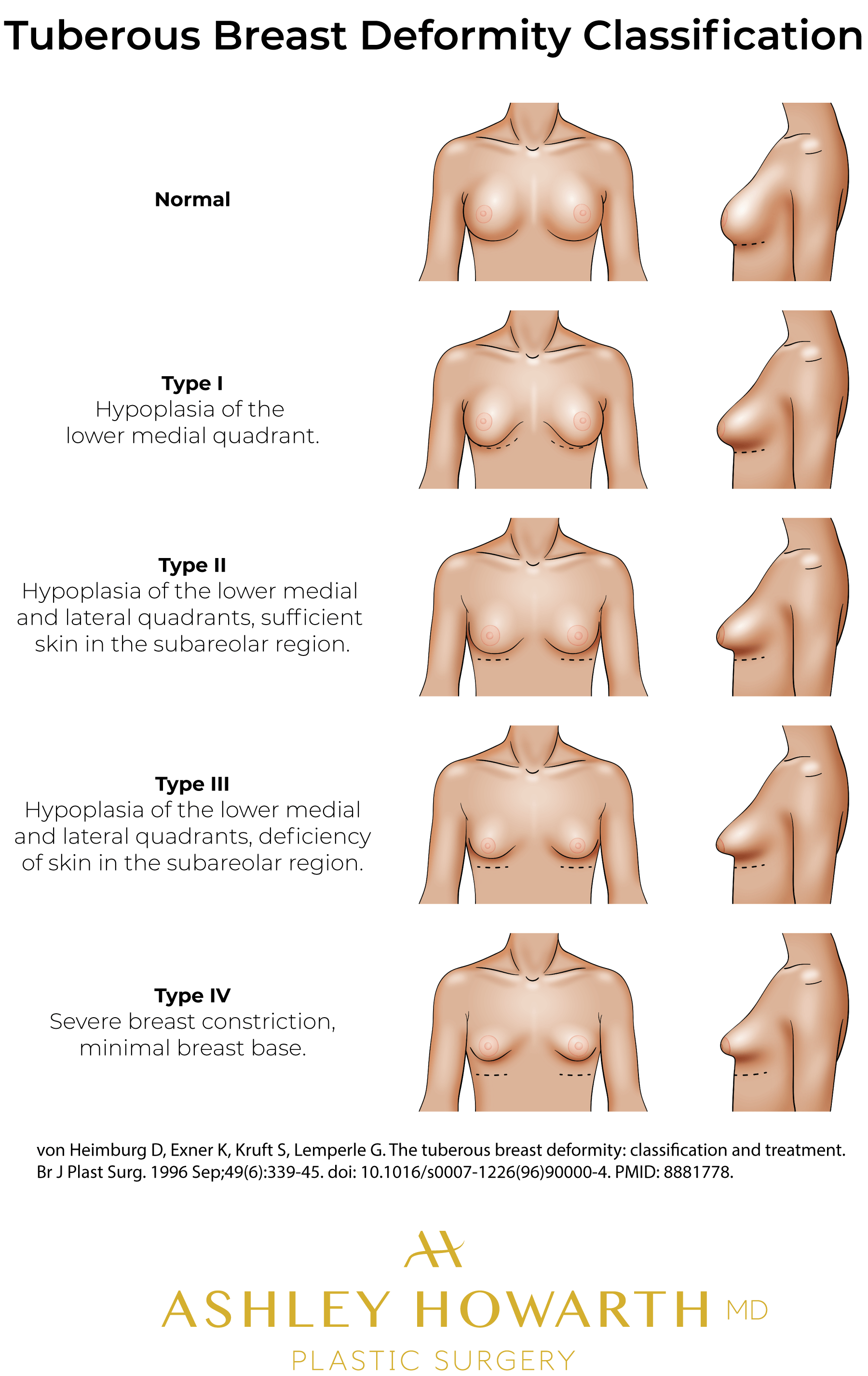 Tubular Breasts - Tuberous Breast Deformity Classification