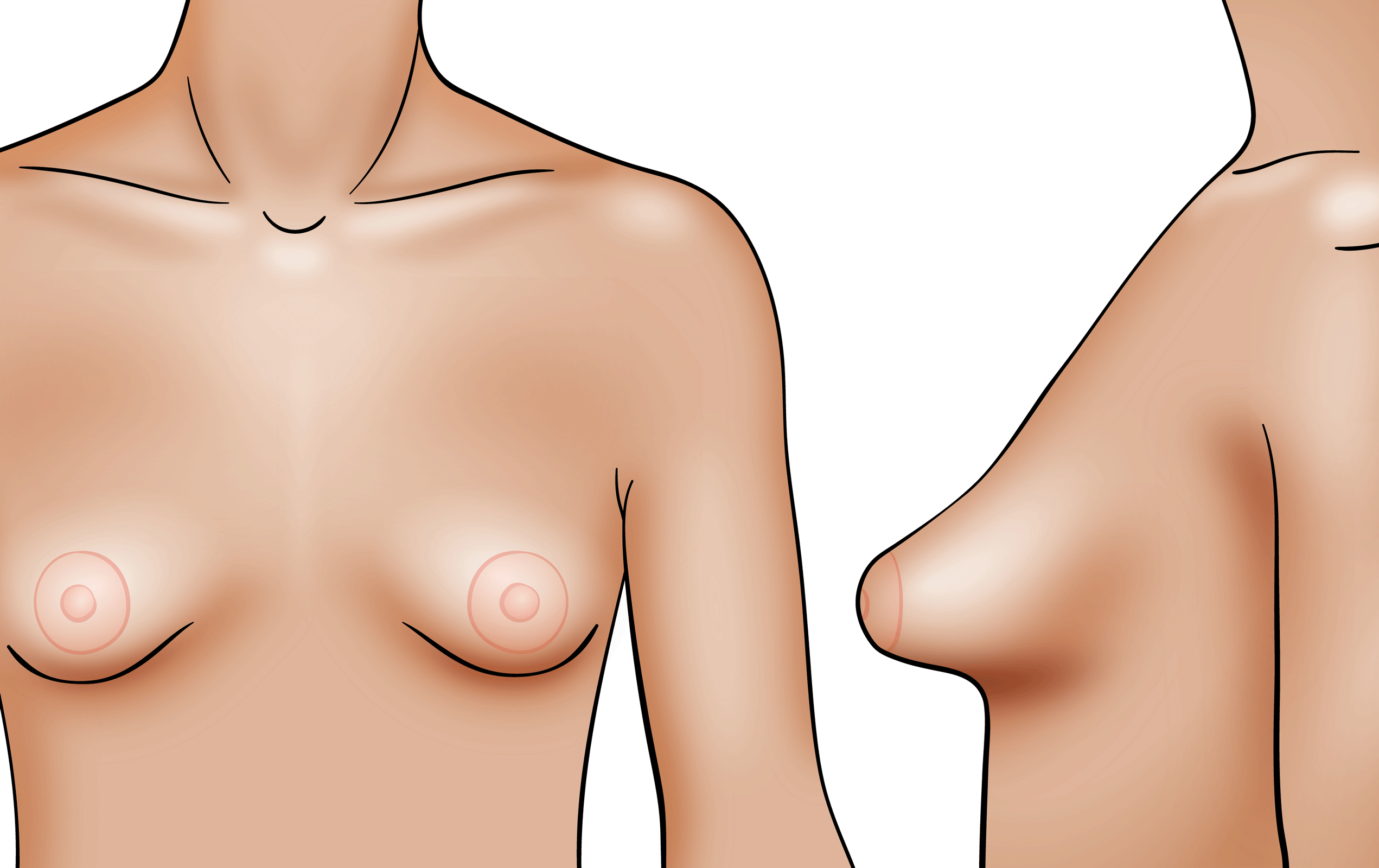 What do tubular breasts look like? Fix tuberous breasts Scottsdale AZ