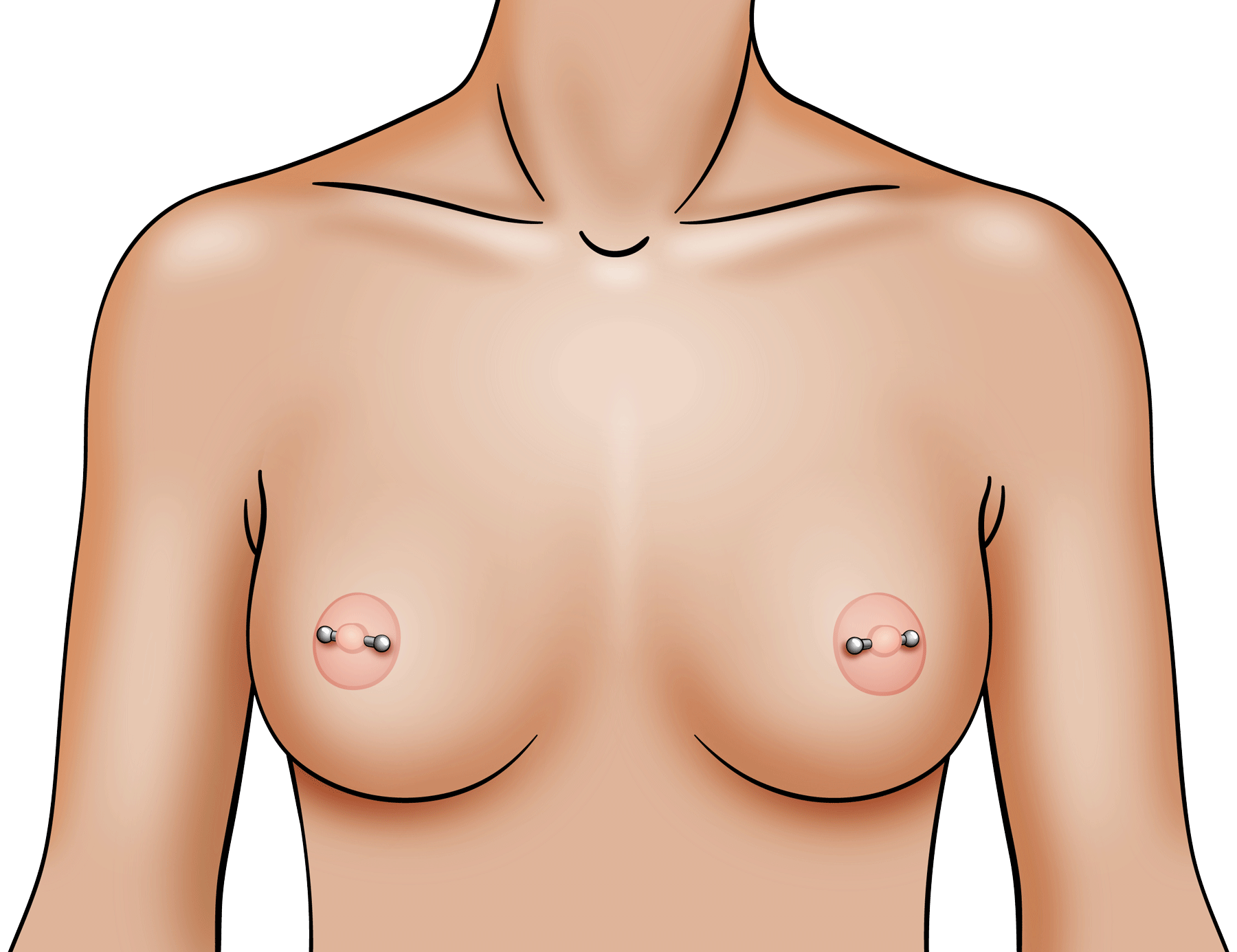 Can I get breast implants if I have a nipple piercing?