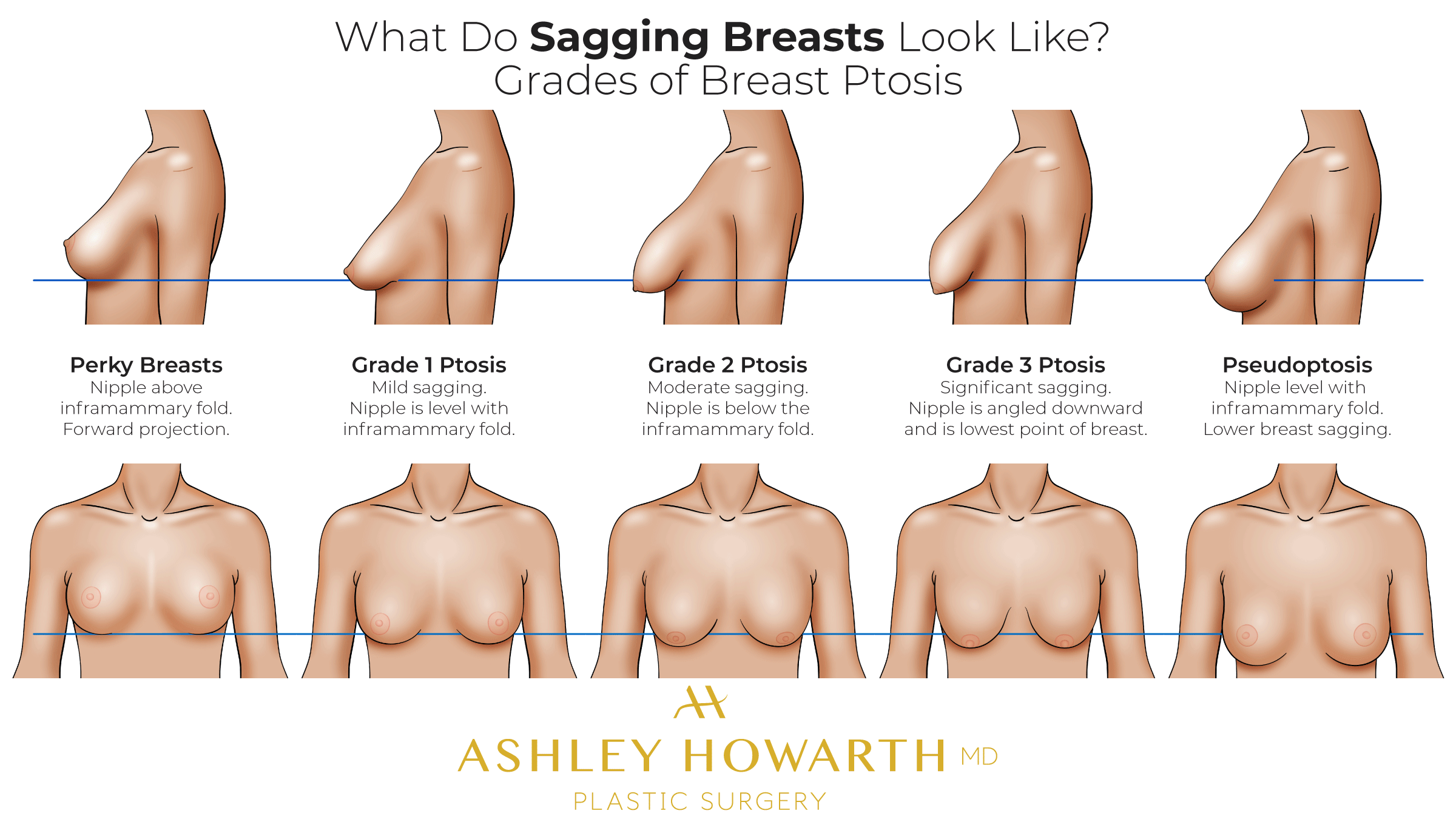 Pictures Of Saggy Breasts